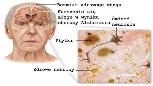 Bejsment Choroba Alzheimera Jak Się Przed Nią Ustrzec 6120