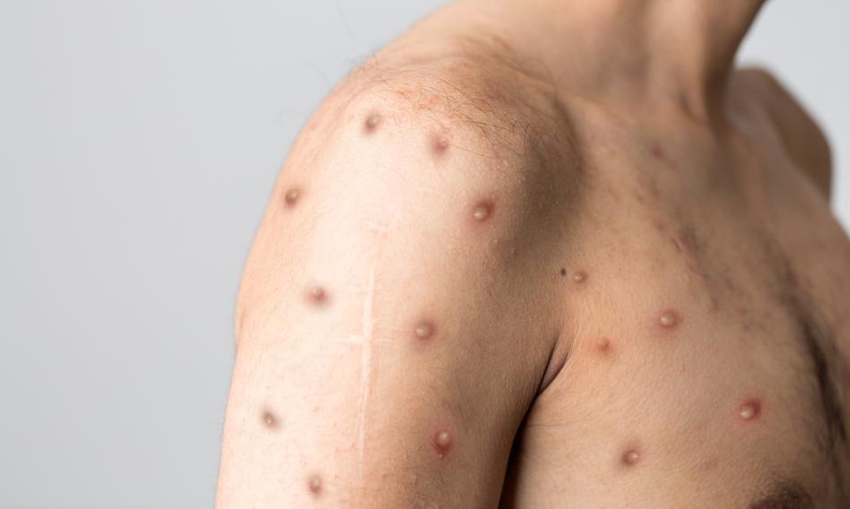 WHO alarmuje: mpox szerzy się w Afryce i dociera do Europy