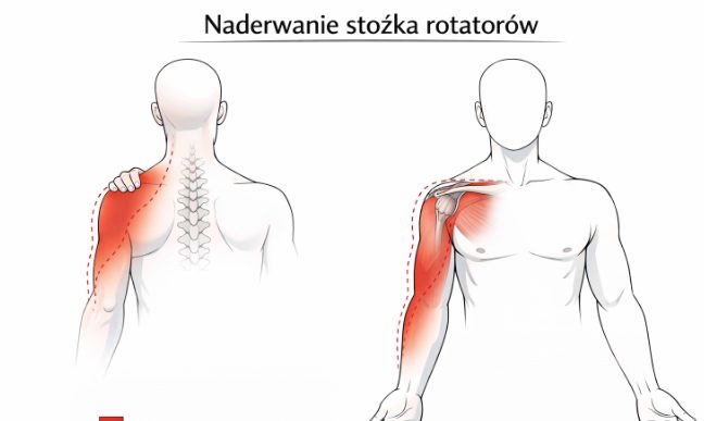 Jak odróżnić rwę barkową od naderwania mięśni ramienia?