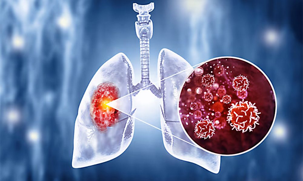 Rak wraca częściej u młodych