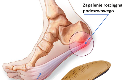 Kiedy wkładki do butów skutecznie pomagają na bóle stóp