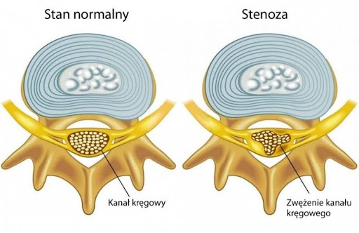 Bóle pleców —stenoza kanału kręgowego