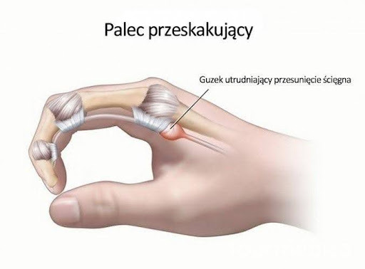 Palec przeskakujący (trigger finger) – mały problem, który potrafi mocno ograniczyć rękę