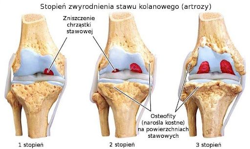 Artretyzm — co to jest i jak sobie z nim radzić?