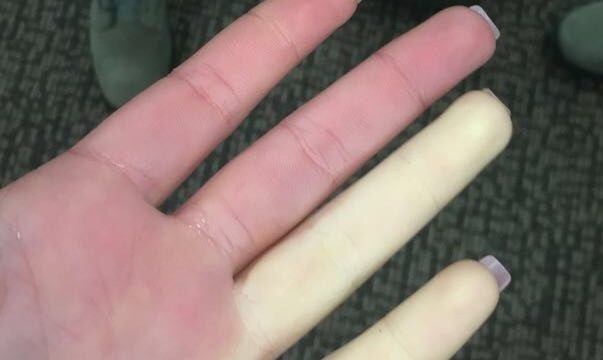 Choroba Raynauda