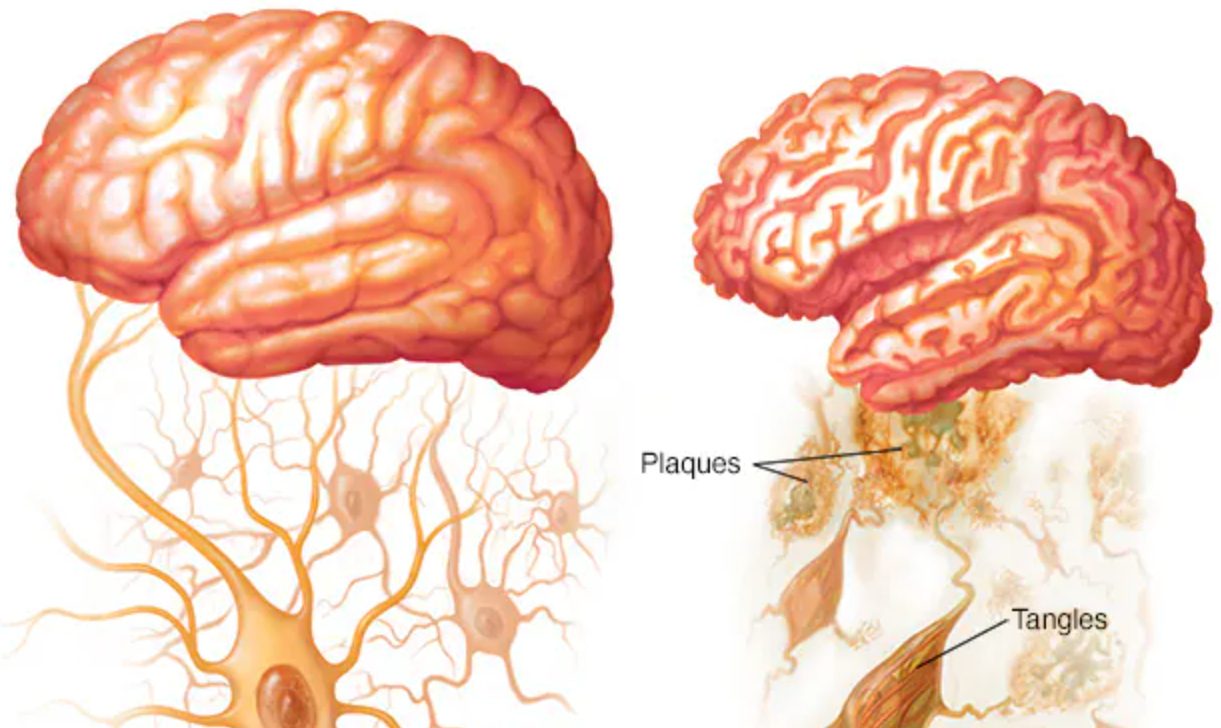 Choroba alzheimera